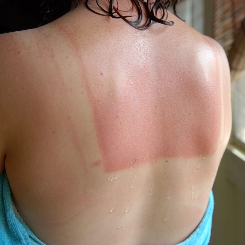 Quelle huile pour apaiser les coups de soleil ? #CBD 16 Coups de soleil : symptômes