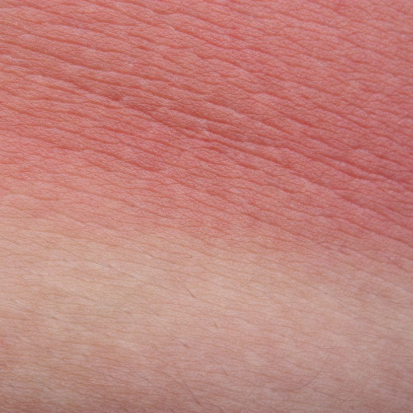 Quelle huile pour apaiser les coups de soleil ? #CBD 17 peau1