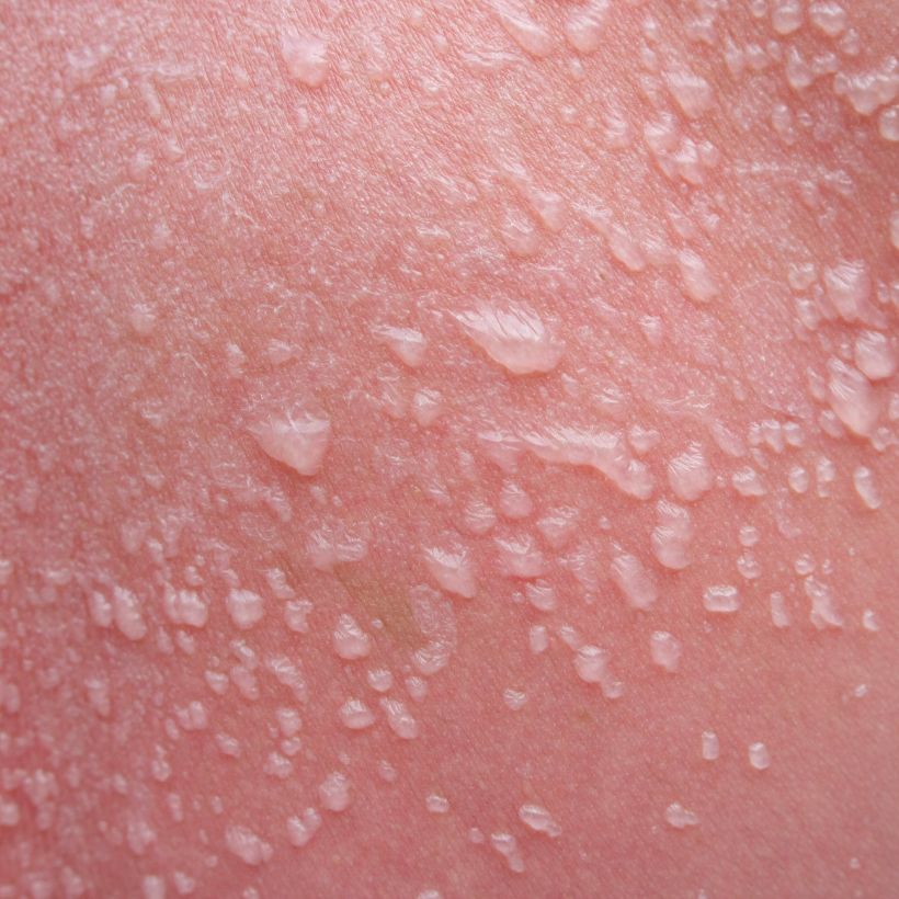 Quelle huile pour apaiser les coups de soleil ? #CBD 18 peau2
