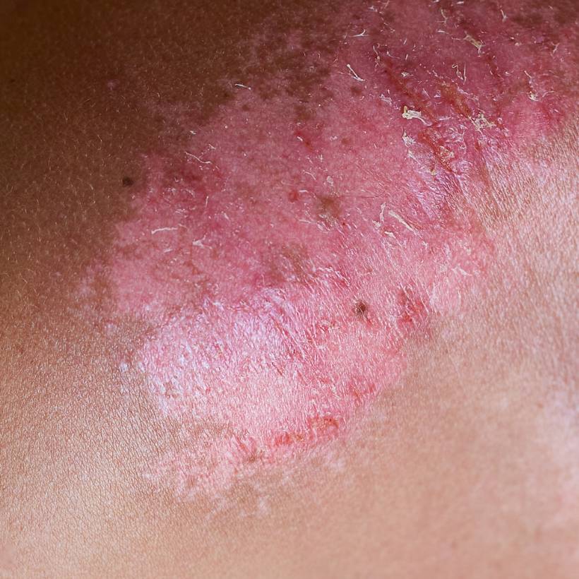 Quelle huile pour apaiser les coups de soleil ? #CBD 19 peau3OK